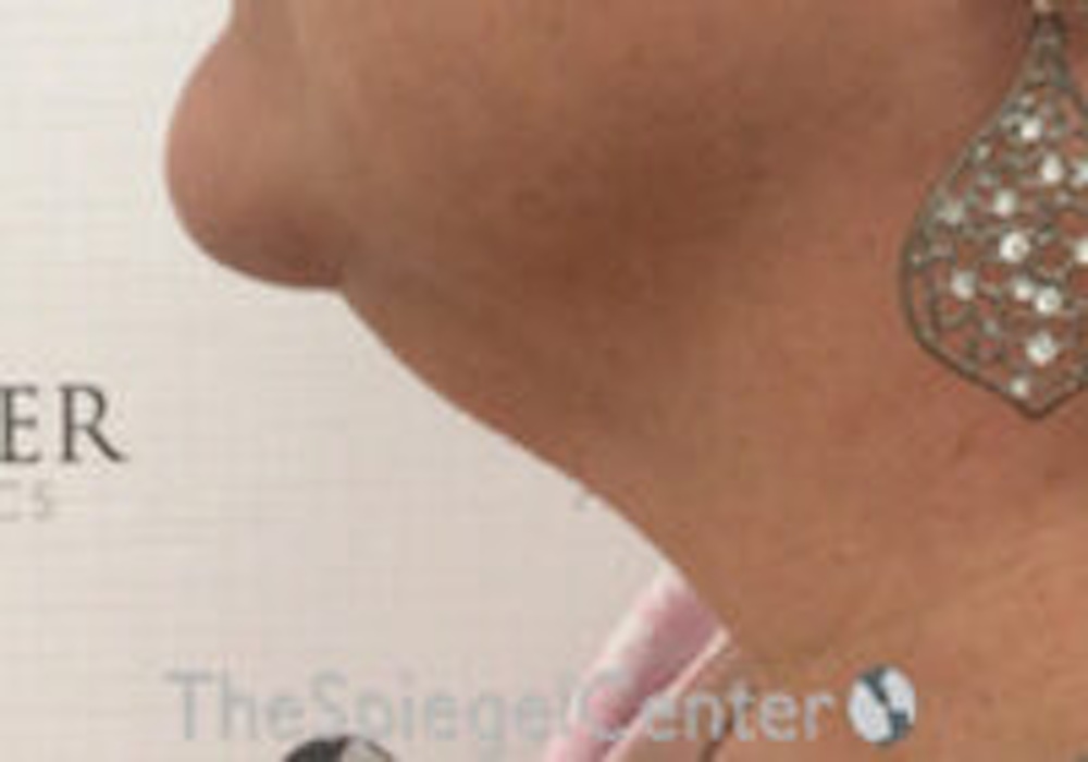 Before and After photos of neck lift in Boston