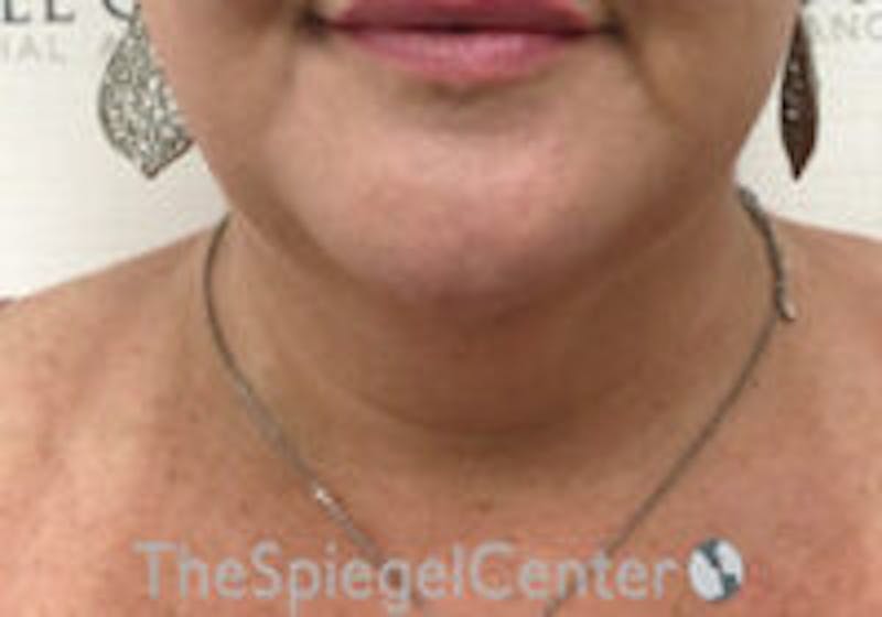 Neck Lift Before & After Gallery - Patient 247300 - Image 3