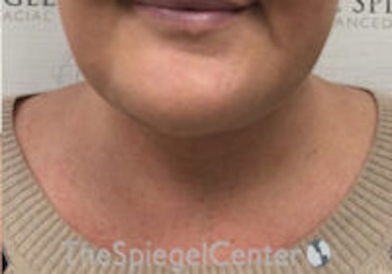 Neck Lift Before & After Gallery - Patient 247300 - Image 4
