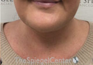 Neck Lift Before & After Gallery - Patient 247300 - Image 4