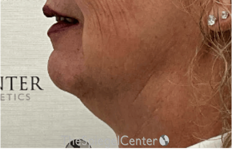 Neck Lift Before & After Gallery - Patient 354843 - Image 1