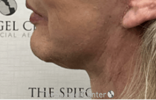 Neck Lift Before & After Gallery - Patient 354843 - Image 2