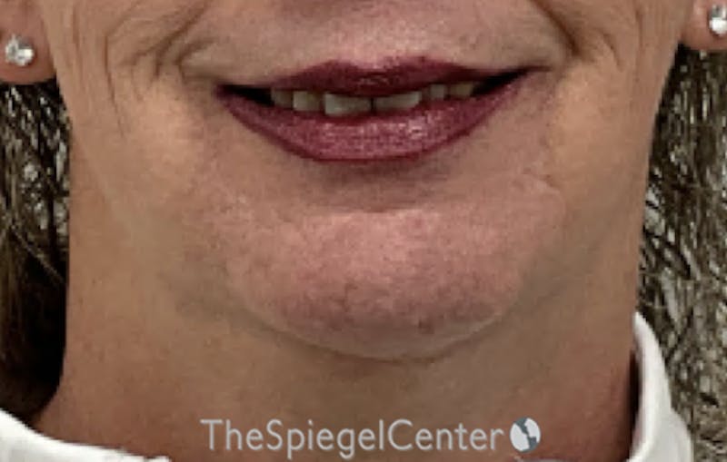 Neck Lift Before & After Gallery - Patient 354843 - Image 3