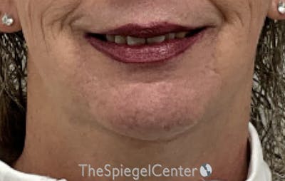 Neck Lift Before & After Gallery - Patient 354843 - Image 3