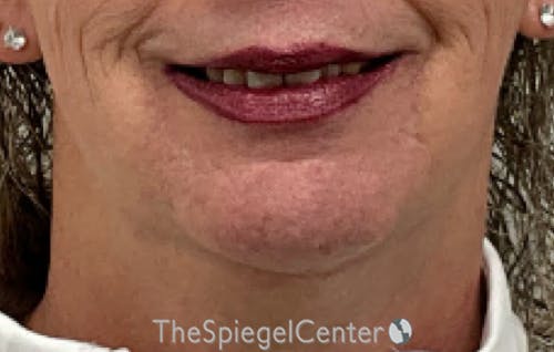 Neck Lift Before & After Gallery - Patient 354843 - Image 3