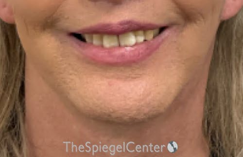 Neck Lift Before & After Gallery - Patient 354843 - Image 4