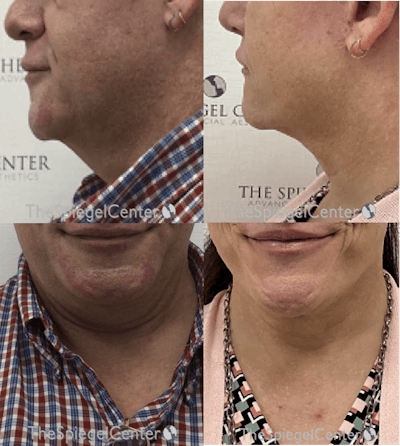 Neck Lift Before & After Gallery - Patient 987241 - Image 1