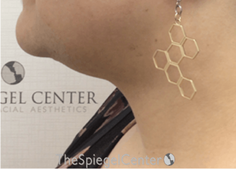 Neck Lift Before & After Gallery - Patient 184724 - Image 2