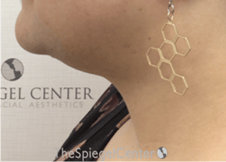 Neck Lift Before & After Gallery - Patient 184724 - Image 2