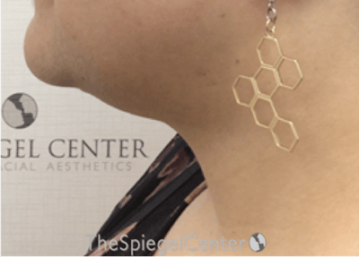 Neck Lift Before & After Gallery - Patient 184724 - Image 2