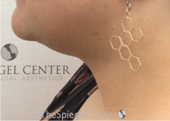 Neck Lift Before & After Gallery - Patient 184724 - Image 2