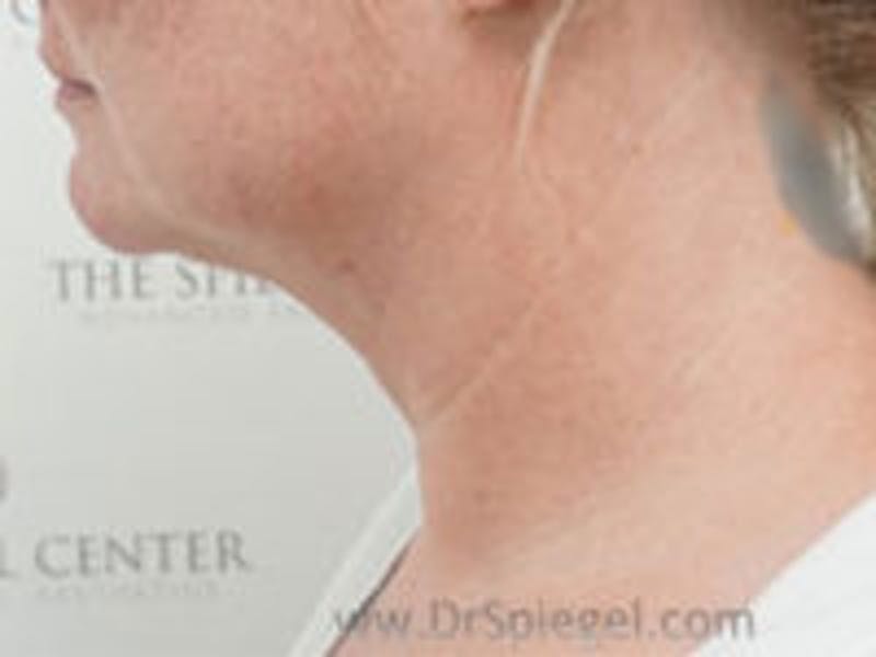 Neck Lift Before & After Gallery - Patient 255687 - Image 1