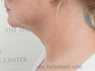 Neck Lift Before & After Gallery - Patient 255687 - Image 1