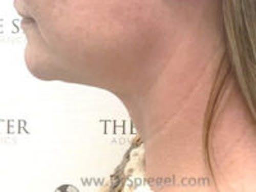 Neck Lift Before & After Gallery - Patient 255687 - Image 2