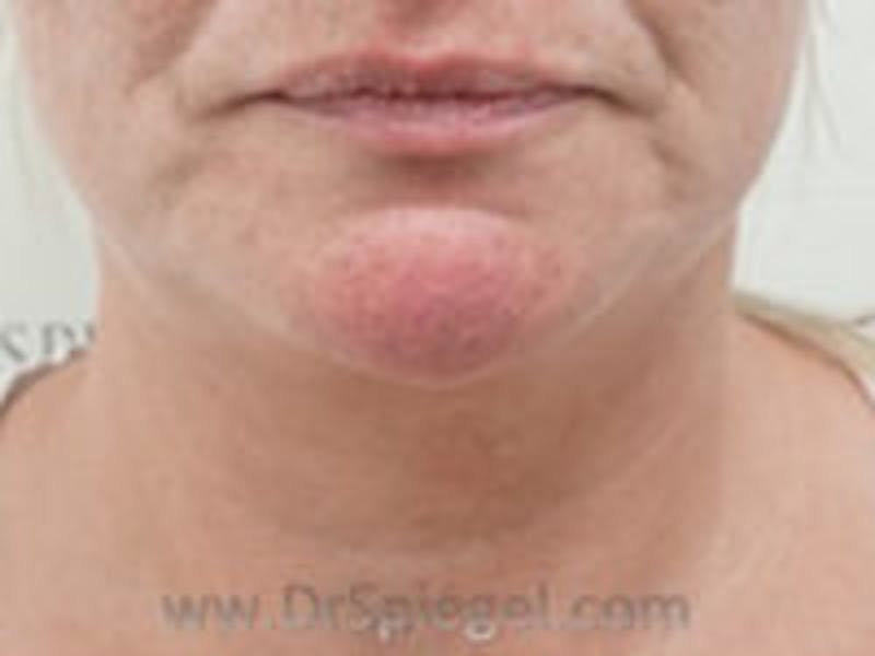 Neck Lift Before & After Gallery - Patient 255687 - Image 3