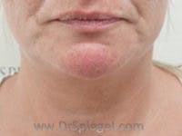 Neck Lift Before & After Gallery - Patient 255687 - Image 3