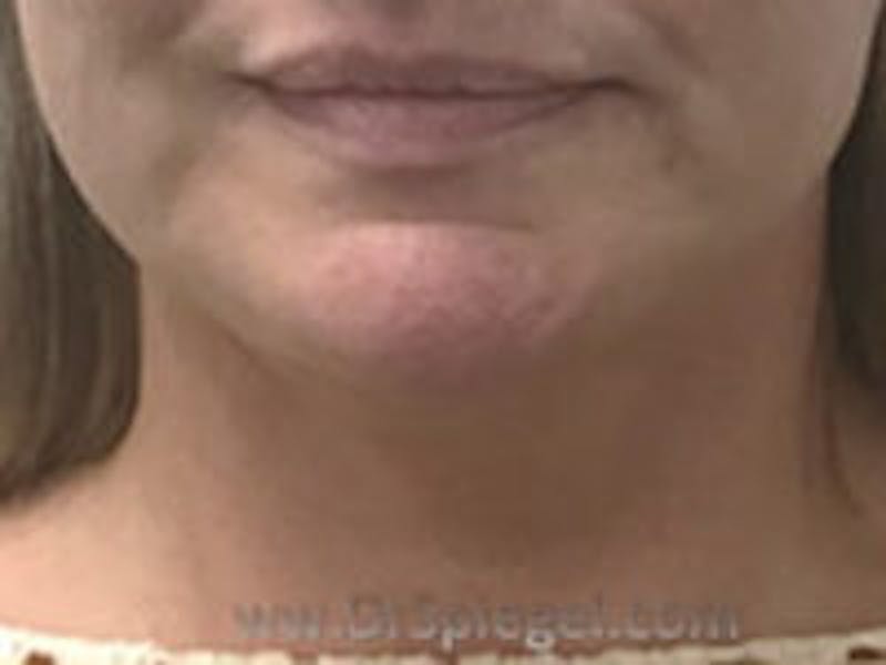 Neck Lift Before & After Gallery - Patient 255687 - Image 4