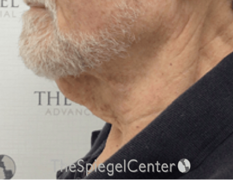 Neck Lift Before & After Gallery - Patient 209672 - Image 1