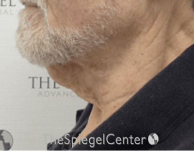 Neck Lift Before & After Gallery - Patient 209672 - Image 1