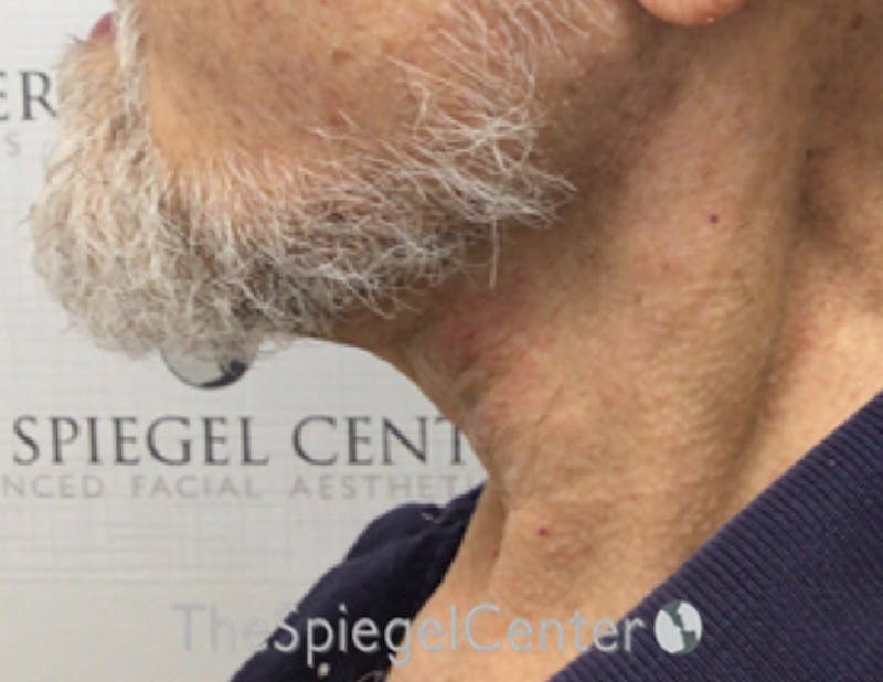 Neck Lift Before & After Gallery - Patient 209672 - Image 2
