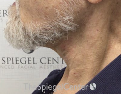 Neck Lift Before & After Gallery - Patient 209672 - Image 2