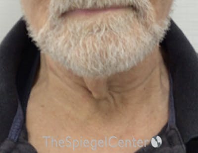 Neck Lift Before & After Gallery - Patient 209672 - Image 3