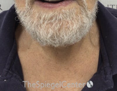 Neck Lift Before & After Gallery - Patient 209672 - Image 4