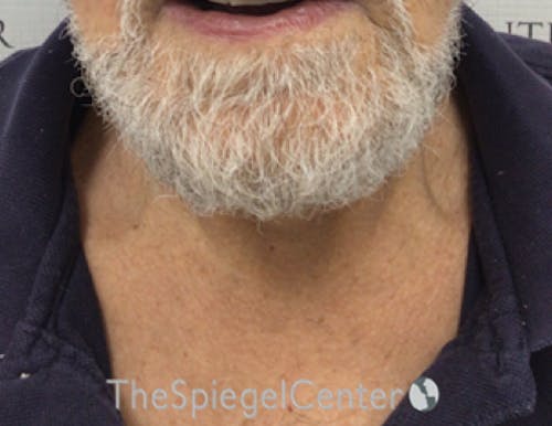 Neck Lift Before & After Gallery - Patient 209672 - Image 4