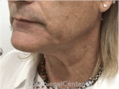 Neck Lift Before & After Gallery - Patient 184956 - Image 1