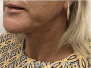 Neck Lift Before & After Gallery - Patient 184956 - Image 2