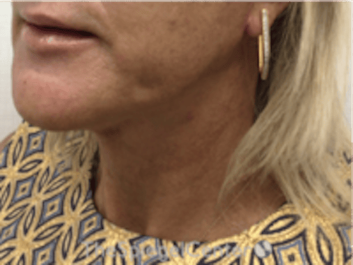Neck Lift Before & After Gallery - Patient 184956 - Image 2