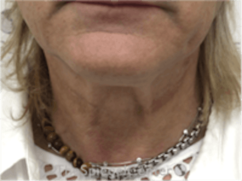 Neck Lift Before & After Gallery - Patient 184956 - Image 3