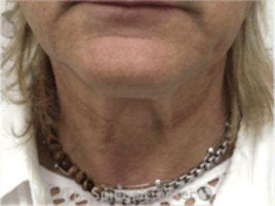 Neck Lift Before & After Gallery - Patient 184956 - Image 3