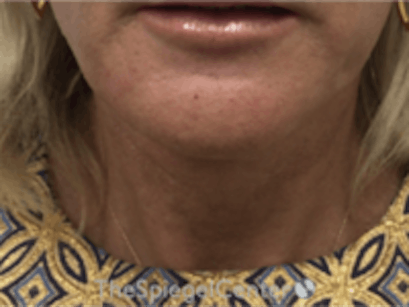 Neck Lift Before & After Gallery - Patient 184956 - Image 4