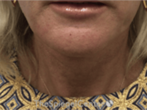 Neck Lift Before & After Gallery - Patient 184956 - Image 4
