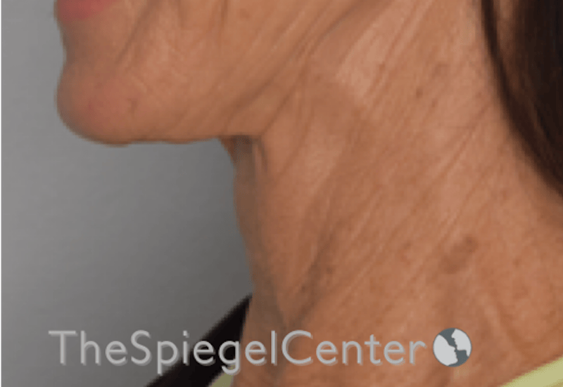 Neck Lift Before & After Gallery - Patient 303581 - Image 1