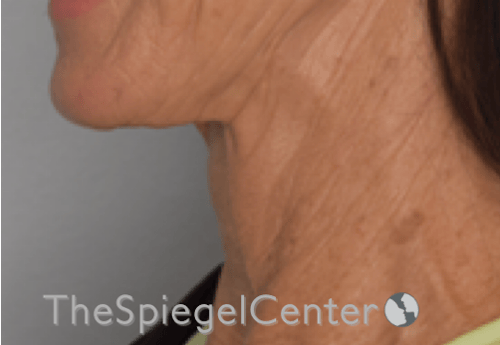 Neck Lift Before & After Gallery - Patient 303581 - Image 1