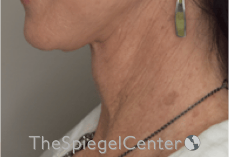 Neck Lift Before & After Gallery - Patient 303581 - Image 2