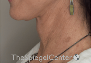 Neck Lift Before & After Gallery - Patient 303581 - Image 2
