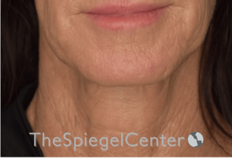 Neck Lift Before & After Gallery - Patient 303581 - Image 3