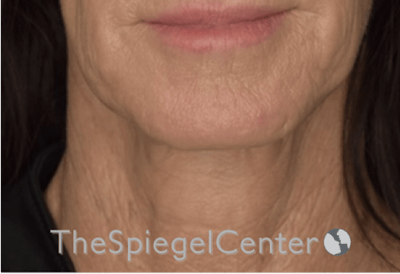 Neck Lift Before & After Gallery - Patient 303581 - Image 3