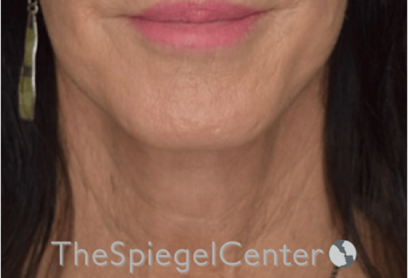 Neck Lift Before & After Gallery - Patient 303581 - Image 4