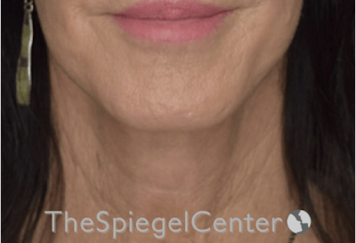 Neck Lift Before & After Gallery - Patient 303581 - Image 4