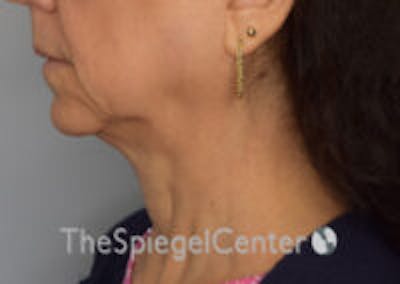 Neck Lift Before & After Gallery - Patient 248476 - Image 1