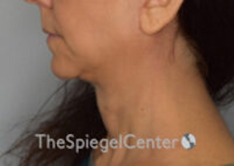 Neck Lift Before & After Gallery - Patient 248476 - Image 2