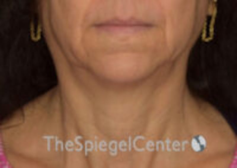 Neck Lift Before & After Gallery - Patient 248476 - Image 3
