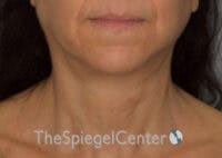 Neck Lift Before & After Gallery - Patient 248476 - Image 4