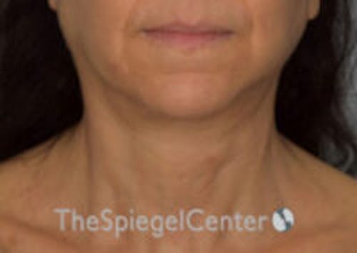 Neck Lift Before & After Gallery - Patient 248476 - Image 4
