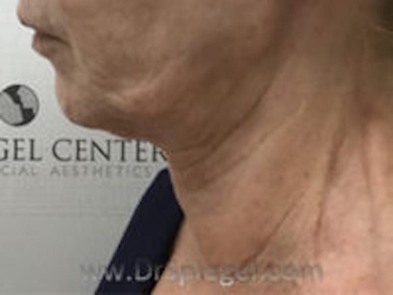 Neck Lift Before & After Gallery - Patient 126132 - Image 1