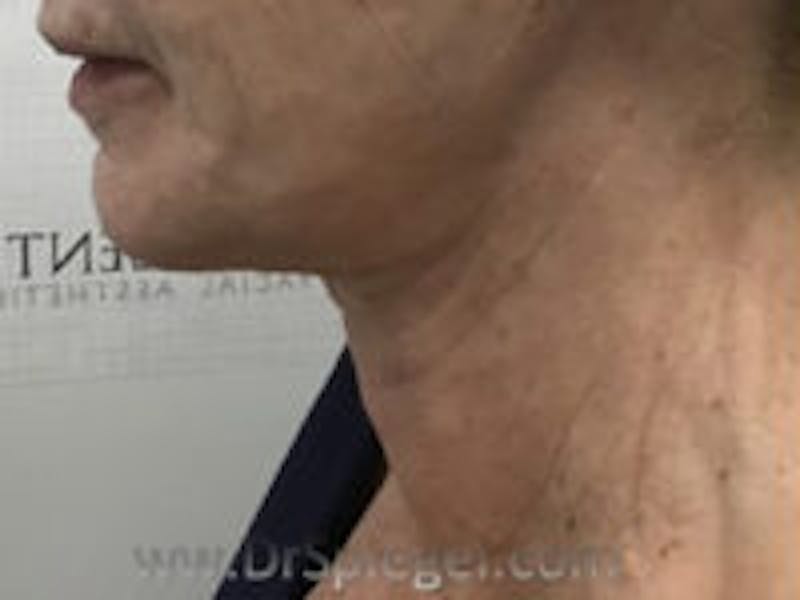 Neck Lift Before & After Gallery - Patient 126132 - Image 2